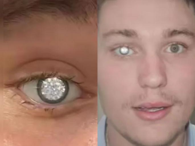 man replaces lost eye with 2 carat diamond world most expensive artificial eye photos goes viral | शौक बड़ी चीज है! दृष्टी गमावताच डोळ्यात बसवला २ कॅरेटचा हिरा, रंगली तुफान चर्चा man replaces lost eye with 2 carat diamond world most expensive artificial eye photos goes viral | शौक बड़ी चीज है! दृष्टी गमावताच डोळ्यात बसवला २ कॅरेटचा हिरा, रंगली तुफान चर्चा