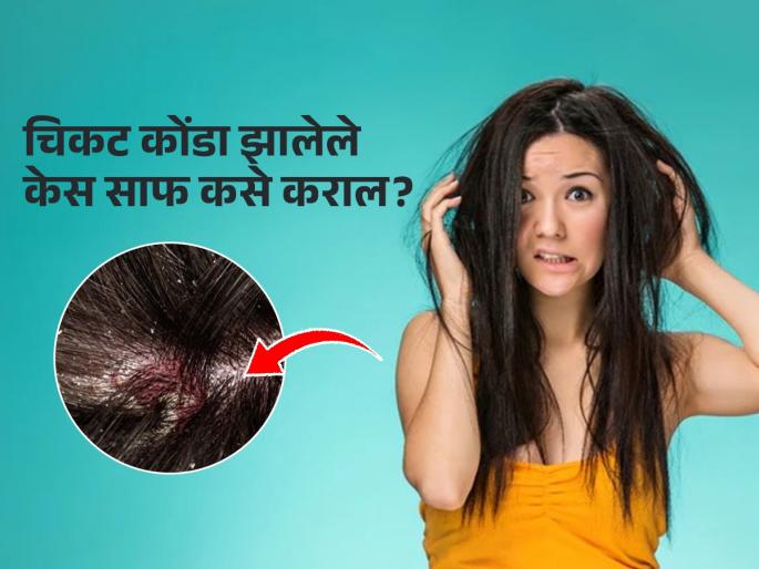 Home remedy to get rid off your sticky hair in humidity | केसांमधील चिकटपणा, वाढलेला कोंडा लगेच होईल साफ; फॉलो करा या सोप्या टिप्स, केस होतील चमकदार