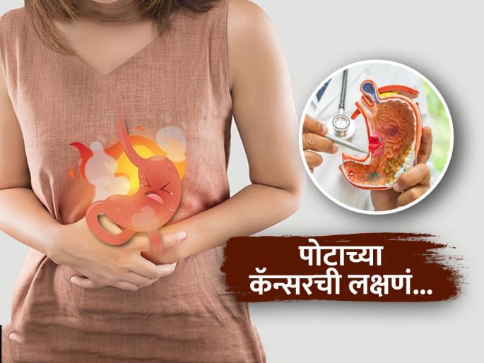 Stomach Cancer Sign : Acidity and sour burps can be early signs of stomach cancer | आंबट-करपट ढेकर आणि छातीत सतत जळजळ, पोटाच्या कॅन्सरचीही असू शकतात लक्षणं-वेळीच तपासा