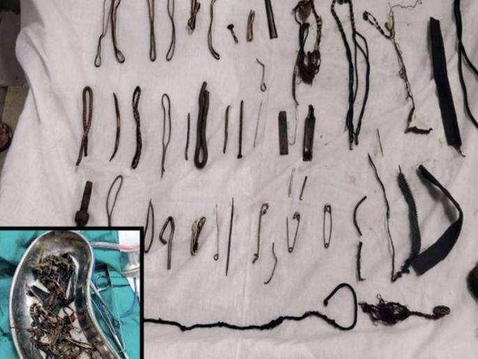 Ahmadabad woman stomach iron, nails, nuts and bolts,safety pins | धक्कादायक! महिलेच्या पोटात दीड किलो खिळे, नट-बोल्ट; डॉक्टरही हैराण! Ahmadabad woman stomach iron, nails, nuts and bolts,safety pins | धक्कादायक! महिलेच्या पोटात दीड किलो खिळे, नट-बोल्ट; डॉक्टरही हैराण!