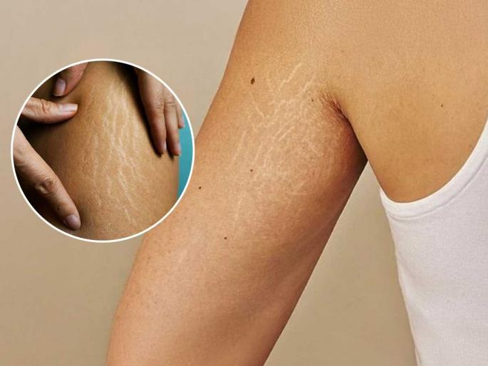 4 ways to reduce stretch marks on the stomach and thighs, even sagging skin will become strong and firm | पोटावरचे-मांड्यांवरचे स्ट्रेचमार्क कमी करण्यासाठी ४ उपाय, थुलथुलीत त्वचाही होईल स्ट्रॉंग आणि तुकतुकीत