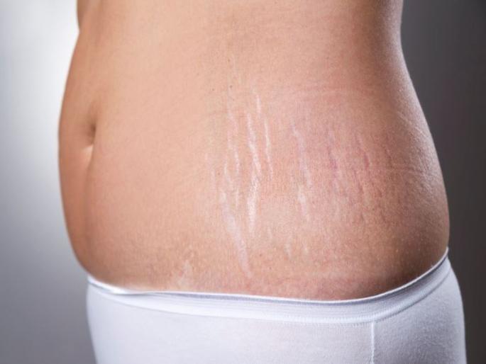 This is how you can prevent stretch marks after weight loss | वजन कमी केल्यानंतर आलेले स्ट्रेच मार्क्स कसे दूर कराल?; जाणून घ्या उपाय This is how you can prevent stretch marks after weight loss | वजन कमी केल्यानंतर आलेले स्ट्रेच मार्क्स कसे दूर कराल?; जाणून घ्या उपाय