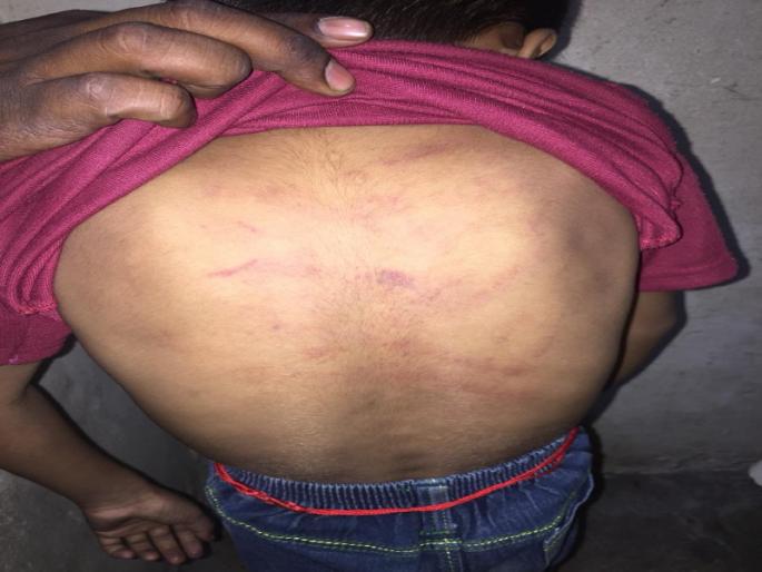 The first standred student assassinated by teacher at Rajgurunagar | राजगुरुनगर येथे शिक्षकाची पहिलीच्या विद्यार्थ्याला बेदम मारहाण The first standred student assassinated by teacher at Rajgurunagar | राजगुरुनगर येथे शिक्षकाची पहिलीच्या विद्यार्थ्याला बेदम मारहाण