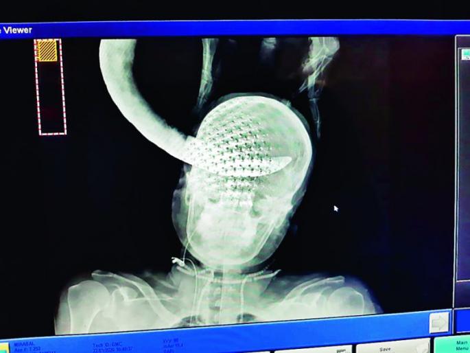 Safe out sickle pierced in the head: Life for a woman | डोक्यात खोल रुतलेला विळा सुरक्षित बाहेर : महिलेला जीवनदान Safe out sickle pierced in the head: Life for a woman | डोक्यात खोल रुतलेला विळा सुरक्षित बाहेर : महिलेला जीवनदान