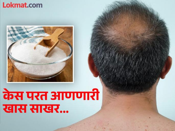 Men suffering from baldness study claims sugar grains can regrow hair | जगभरातील पुरूष टक्कल पडण्याला वैतागले, रिसर्चचा दावा साखरेच्या दाण्यांमुळे परत येऊ शकतात केस! Men suffering from baldness study claims sugar grains can regrow hair | जगभरातील पुरूष टक्कल पडण्याला वैतागले, रिसर्चचा दावा साखरेच्या दाण्यांमुळे परत येऊ शकतात केस!