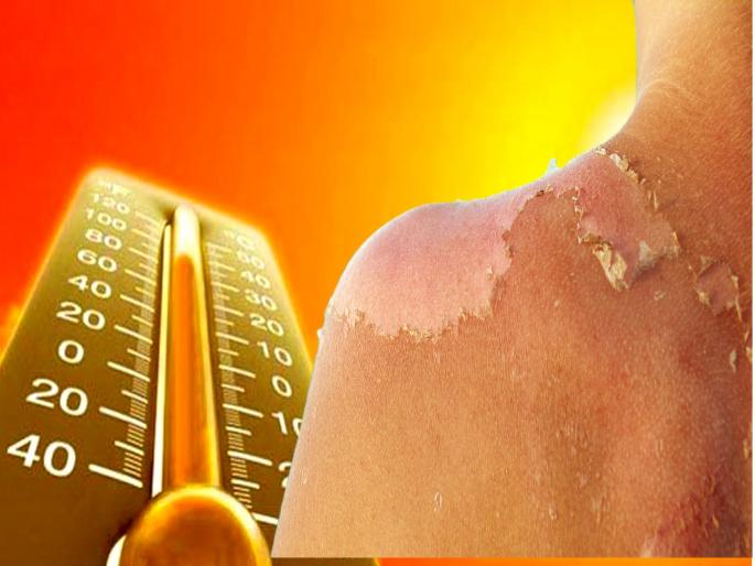 The sun is burning, burning the skin in ten minutes; what exactly is 'sunburn'? | सूर्य आग ओकतोय, दहा मिनिटांत कातडी भाजतेय; ‘सनबर्न’ म्हणजे नेमकं काय? The sun is burning, burning the skin in ten minutes; what exactly is 'sunburn'? | सूर्य आग ओकतोय, दहा मिनिटांत कातडी भाजतेय; ‘सनबर्न’ म्हणजे नेमकं काय?