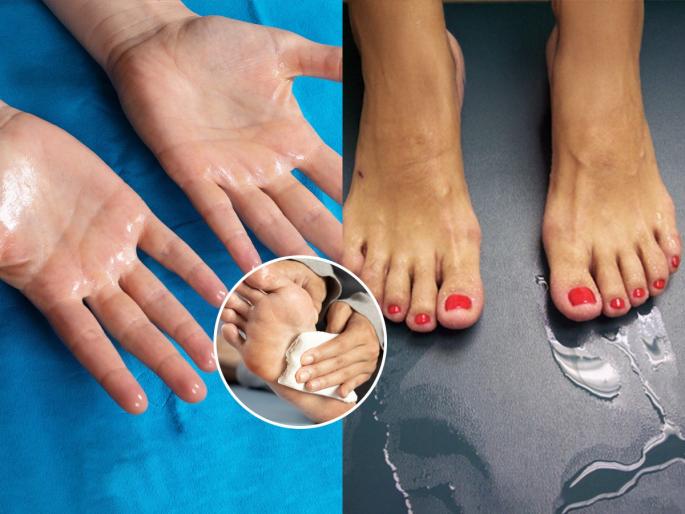 sweaty palms and feet? see the reasons , ignoring it can be extremely dangerous. | हाता-पायाच्या तळव्यांना घाम येतो? ओले राहतात सतत? कारण आहे गंभीर, दुर्लक्ष ठरु शकेल प्रचंड घातक