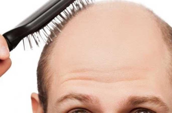 The girl says my status will decrease; Don't marry a bald boy ... | मुलगी म्हणतेय माझं स्टेट्स कमी होईल; टक्कल पडलेल्या मुलाशी लग्न नको गं बाई... The girl says my status will decrease; Don't marry a bald boy ... | मुलगी म्हणतेय माझं स्टेट्स कमी होईल; टक्कल पडलेल्या मुलाशी लग्न नको गं बाई...