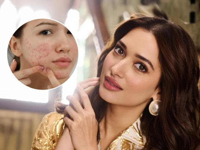 Tamannaah Bhatia Skin Care Hack – Is Saliva Good for Pimples? Know from Skin Experts Tamannaah Bhatia skin care hack Home remedy for pimples Tamannaah Bhatia pimple remedy | पिंपल्स येऊ नयेत म्हणून तमन्ना भाटिया चेहऱ्याला रोज लावते एक विचित्र गोष्ट, पण डॉक्टर म्हणतात...