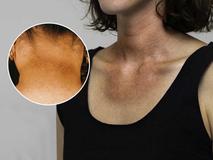 Tanning around the neck makes the face look strange too, check out these easy home remedies to remove tanning | मानेभोवती टॅनिंग म्हणजे चेहराही विचित्रच दिसतो , पाहा हे टॅनिंग घालवण्याचे सोपे - घरगुती उपाय Tanning around the neck makes the face look strange too, check out these easy home remedies to remove tanning | मानेभोवती टॅनिंग म्हणजे चेहराही विचित्रच दिसतो , पाहा हे टॅनिंग घालवण्याचे सोपे - घरगुती उपाय