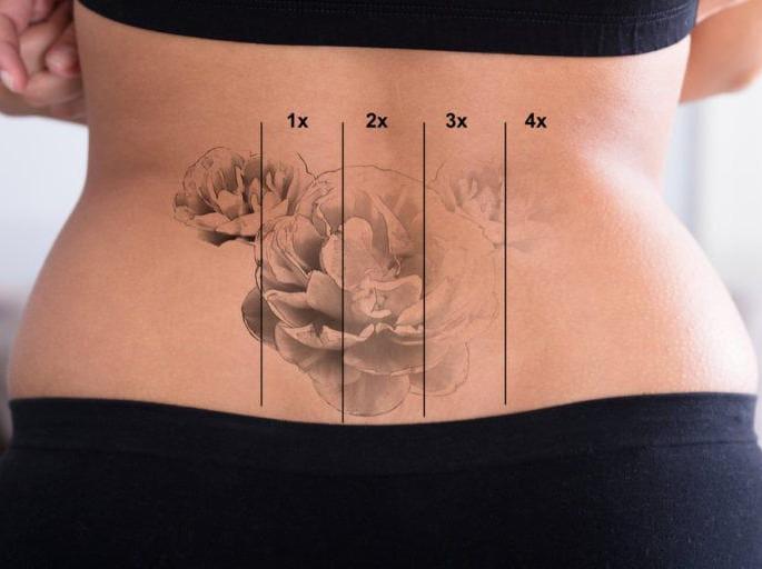 Saying 'I broke up' .. the number of youngsters in medical to get rid of tattoos was increasing | 'मैंने ब्रेकअप कर लिया'.. म्हणत टॅटू मिटवण्यासाठी तरुणाईची मेडिकलमध्ये संख्या वाढती Saying 'I broke up' .. the number of youngsters in medical to get rid of tattoos was increasing | 'मैंने ब्रेकअप कर लिया'.. म्हणत टॅटू मिटवण्यासाठी तरुणाईची मेडिकलमध्ये संख्या वाढती