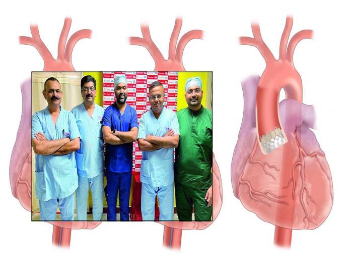 'Valve replacement' done without a stitch; 'Tawi' procedure gave life to the old man | एकही टाका न लावता केले ‘व्हॉल्व्ह रिप्लेसमेंट’; ‘टावी’ प्रक्रियेने वृद्धाला मिळाले जीवनदान
