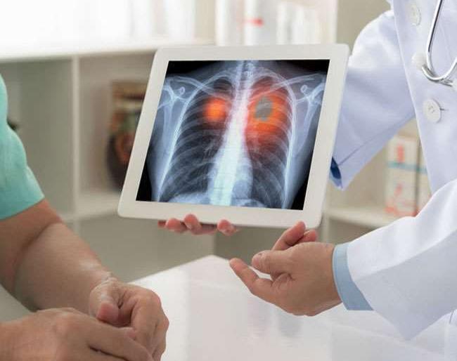 6 TB cases found in Nashik; Muncipal Search Mission | नाशिकमध्ये आढळले ६ क्षयरोगी; मनपाची शोध मोहीम 6 TB cases found in Nashik; Muncipal Search Mission | नाशिकमध्ये आढळले ६ क्षयरोगी; मनपाची शोध मोहीम