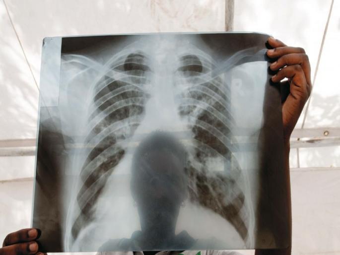Oh my God! 6 new TB patients daily in Chhatrapati Sambhajinagar district, how long has the cough been going on? Keep an eye out | बापरे! छत्रपती संभाजीनगर जिल्ह्यात रोज ६ नवे टीबी रुग्ण, किती दिवसांपासून खोकला? लक्ष ठेवा Oh my God! 6 new TB patients daily in Chhatrapati Sambhajinagar district, how long has the cough been going on? Keep an eye out | बापरे! छत्रपती संभाजीनगर जिल्ह्यात रोज ६ नवे टीबी रुग्ण, किती दिवसांपासून खोकला? लक्ष ठेवा