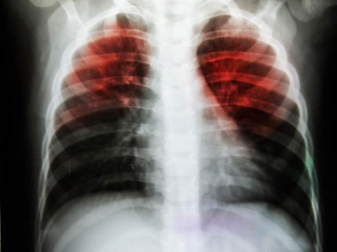 diabetes, smoking, low weight; Half three lakh people in Latur district are at high risk of tuberculosis! | मधुमेह, धुम्रपान, कमी वजन; लातूर जिल्ह्यातील सव्वातीन लाख व्यक्ती क्षयरोगाच्या अतिजाेखमीत! diabetes, smoking, low weight; Half three lakh people in Latur district are at high risk of tuberculosis! | मधुमेह, धुम्रपान, कमी वजन; लातूर जिल्ह्यातील सव्वातीन लाख व्यक्ती क्षयरोगाच्या अतिजाेखमीत!