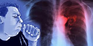 335 tuberculosis patients in two months in Vasai-Virar | वसई-विरारला कोरोनासह क्षयबाधेचाही घट्ट विळखा, दोन महिन्यांत ३३५ क्षयरुग्ण