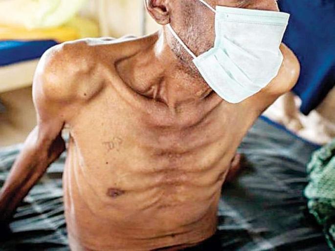 Every year two lakh tuberculosis cases are reported in Maharashtra | महाराष्ट्रात दरवर्षी दोन लाख क्षयरोग्यांची नोंद