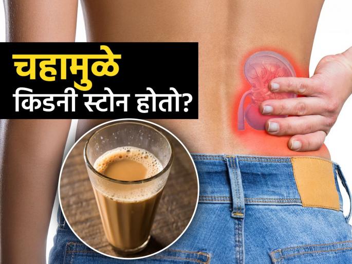 Why and how are people linking it to kidney stones | चहा किडनीसाठी विष असतो का? किडनीमध्ये स्टोनचंही कारण ठरतो का? पाहा एक्सपर्टचं मत...