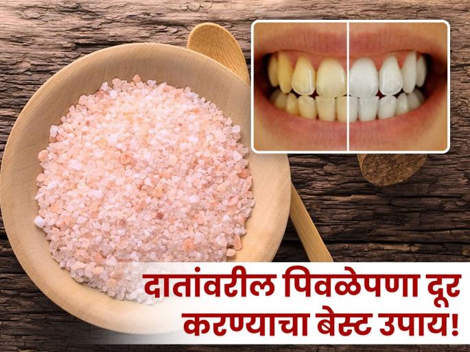 American Doctor told best home remedy to remove plaque from teeth | दातांवरील पिवळेपणा मूळापासून होईल दूर, डॉक्टरांनी सांगितला एक खास घरगुती उपाय! American Doctor told best home remedy to remove plaque from teeth | दातांवरील पिवळेपणा मूळापासून होईल दूर, डॉक्टरांनी सांगितला एक खास घरगुती उपाय!