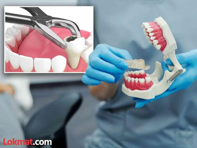 China Man gets 23 teeth extracted and 12 implants placed in one day dies of heart attack | अरे देवा! व्यक्तीचे एका दिवसात 23 दात काढले आणि 12 बसवले, पुढे जे झालं ते वाचून बसेल धक्का... China Man gets 23 teeth extracted and 12 implants placed in one day dies of heart attack | अरे देवा! व्यक्तीचे एका दिवसात 23 दात काढले आणि 12 बसवले, पुढे जे झालं ते वाचून बसेल धक्का...