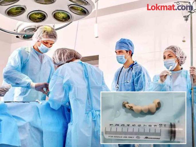 Visakhapatnam man swallows dentures teeth in sleep removed from lung | झोपेत बडबडणं आणि चालण्याबाबत ऐकलं असेलच, पण व्यक्तीने गिळले चक्क नकली दात! Visakhapatnam man swallows dentures teeth in sleep removed from lung | झोपेत बडबडणं आणि चालण्याबाबत ऐकलं असेलच, पण व्यक्तीने गिळले चक्क नकली दात!
