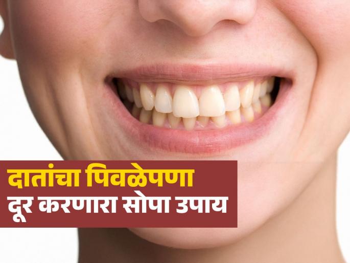 Doctor shares easy remedy whiten your teeth fast with just 2 ingredients | पिवळेपणा दूर होऊन दात होतील मोत्यांसारखे चमकदार, लगेच करा डॉक्टरांनी सांगितलेला 'हा' उपाय!