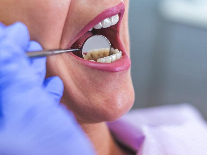 women-sealed-her-teeth-to-reduce-weight-took-big-risk-with-her-teeth | वजन कमी होत नाही म्हणून दातच शिवले, महिलेचे अजब कारनामा women-sealed-her-teeth-to-reduce-weight-took-big-risk-with-her-teeth | वजन कमी होत नाही म्हणून दातच शिवले, महिलेचे अजब कारनामा