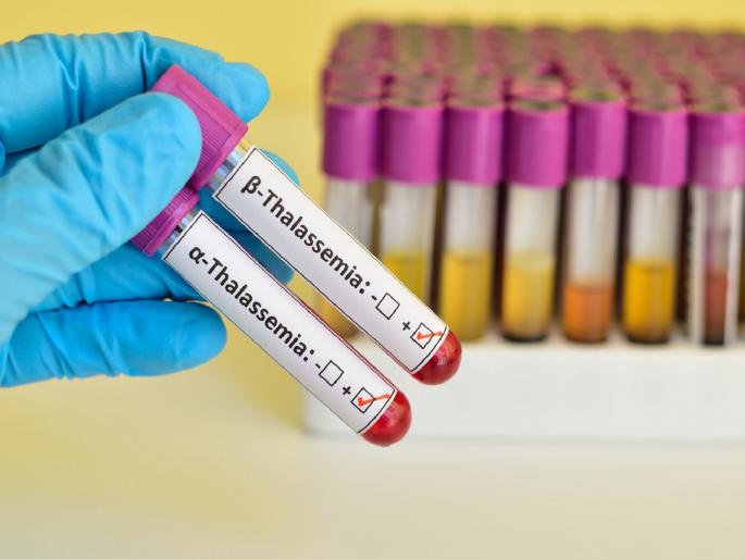 'Bone Marrow Transplant' for Thalassemia patients in Marathwada broke ground | थॅलेसेमियाग्रस्तांसाठी मराठवाड्यामध्ये ‘बोन मॅरो ट्रान्सप्लांट’चा कणा मोडला 'Bone Marrow Transplant' for Thalassemia patients in Marathwada broke ground | थॅलेसेमियाग्रस्तांसाठी मराठवाड्यामध्ये ‘बोन मॅरो ट्रान्सप्लांट’चा कणा मोडला