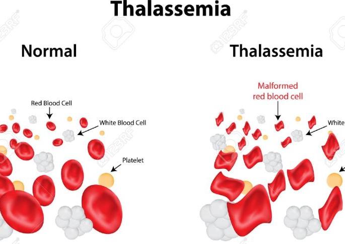 Thalassemia deaths of 1 lakh patients annually | दरवर्षी थॅलेसेमियाच्या १ लाख रुग्णांचा मृत्यू