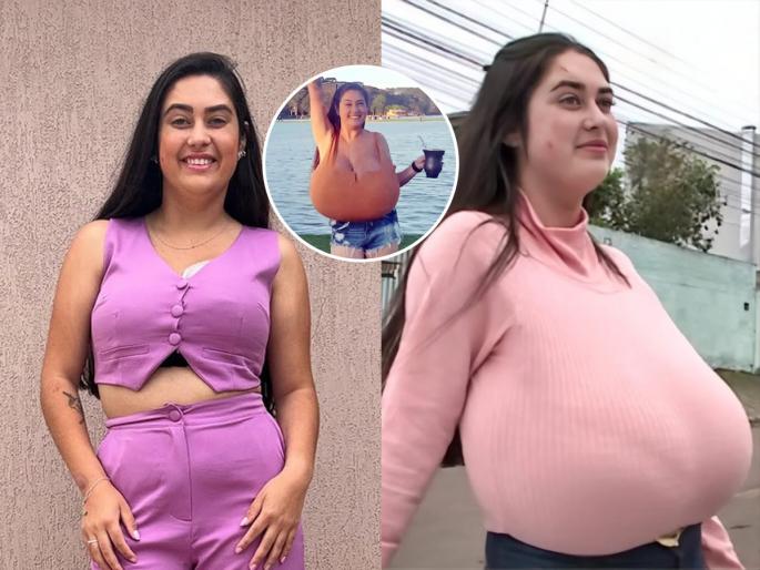 Rare Disease Made This Brazilian Woman Thaynara Marcondes Breasts Grow To 12kg In Months | दुर्मिळ आजारामुळे १२ किलोंनी वाढला तरुणीच्या स्तनांचा आकार, असह्य वेदना होणारा भयंकर आजार