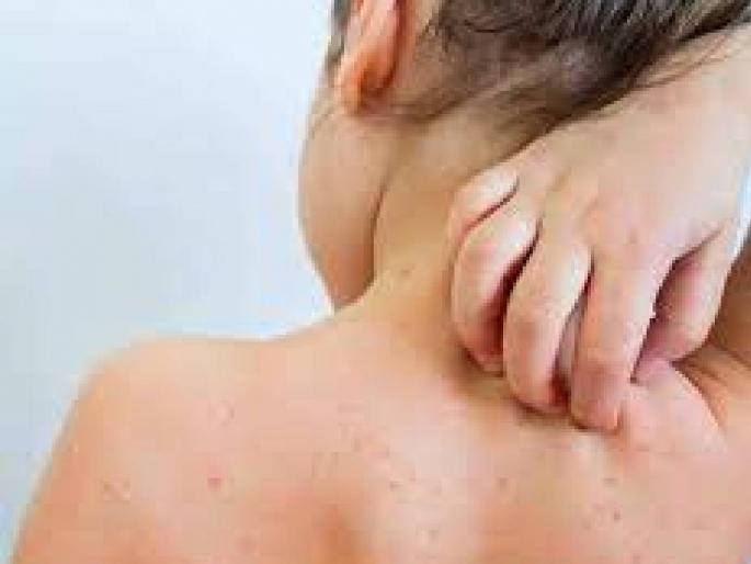 Three children have been found positive for measles in Buldhana district | जिल्ह्यात गोवरची एंट्री, तीन बालके पॉझिटिव्ह; पॉझिटिव्ह रुग्णांवर उपचार सुरु Three children have been found positive for measles in Buldhana district | जिल्ह्यात गोवरची एंट्री, तीन बालके पॉझिटिव्ह; पॉझिटिव्ह रुग्णांवर उपचार सुरु