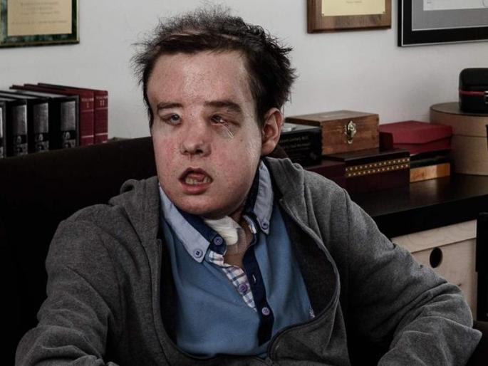 Man with three faces French patient receives second face transplant | तीन चेहऱ्यांचा माणूस कधी पाहिलाय का?