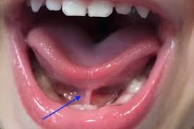 Surgery of 'tongue tie' on 42 patients under 'RBSK' | 'आरबीएसके' अंतर्गत ४२ रुग्णांवर 'टंगटाय'ची शस्त्रक्रिया Surgery of 'tongue tie' on 42 patients under 'RBSK' | 'आरबीएसके' अंतर्गत ४२ रुग्णांवर 'टंगटाय'ची शस्त्रक्रिया