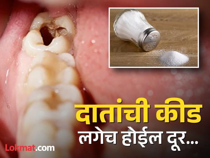 How to use garlic and salt for tooth cavity | मिठात 'ही' एक गोष्ट मिक्स करून दातांवर लावाल तर दूर होईल कीड आणि असह्य दुखणं! How to use garlic and salt for tooth cavity | मिठात 'ही' एक गोष्ट मिक्स करून दातांवर लावाल तर दूर होईल कीड आणि असह्य दुखणं!