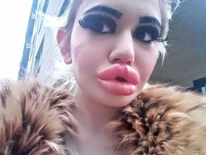 20 times surgery for worlds largest lip see what happened then up myb | खरं सांगताय की मस्करी! मोठे ओठ हवेत; म्हणून तरूणीने तब्बल २० वेळा केली सर्जरी 20 times surgery for worlds largest lip see what happened then up myb | खरं सांगताय की मस्करी! मोठे ओठ हवेत; म्हणून तरूणीने तब्बल २० वेळा केली सर्जरी