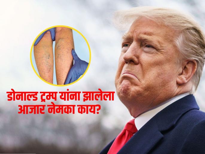 Chronic venous insufficiency: What's chronic venous insufficiency and How dangerous is Donald Trump's disease? | Chrinic venous insufficiency : डोनाल्ड ट्रम्प यांना झालेला नसांचा आजार नेमका काय? पाहा कारणं आणि उपाय..