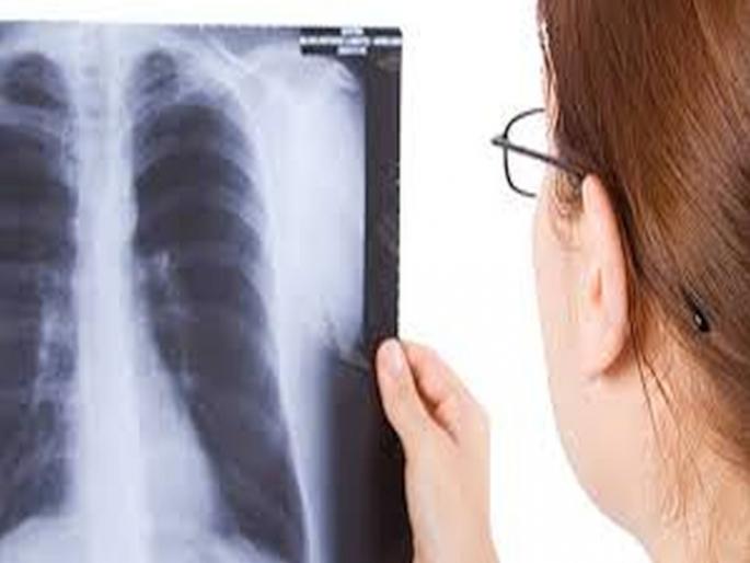 Dharavi area hit by tuberculosis; Information revealed in the center's inspection campaign | धारावी परिसराला क्षयरोगाचा विळखा; केंद्राच्या तपासणी मोहिमेत माहिती उघड  Dharavi area hit by tuberculosis; Information revealed in the center's inspection campaign | धारावी परिसराला क्षयरोगाचा विळखा; केंद्राच्या तपासणी मोहिमेत माहिती उघड