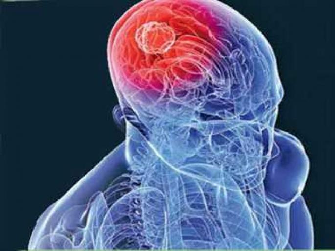 The largest tumor removed from the head, weight 1.8 kilograms; Nair Hospital Surgery | डोक्यातून काढला सर्वांत मोठा ट्युमर, वजन १.८ किलोग्रॅम; नायर रुग्णालयात शस्त्रक्रिया The largest tumor removed from the head, weight 1.8 kilograms; Nair Hospital Surgery | डोक्यातून काढला सर्वांत मोठा ट्युमर, वजन १.८ किलोग्रॅम; नायर रुग्णालयात शस्त्रक्रिया