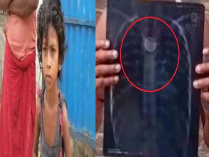 Coin stuck in girl's chest 4 years ago; Suddenly his health deteriorated | ४ वर्षापूर्वी मुलीच्या छातीत अडकलं होतं नाणं; अचानक तब्येत बिघडली, मग... Coin stuck in girl's chest 4 years ago; Suddenly his health deteriorated | ४ वर्षापूर्वी मुलीच्या छातीत अडकलं होतं नाणं; अचानक तब्येत बिघडली, मग...