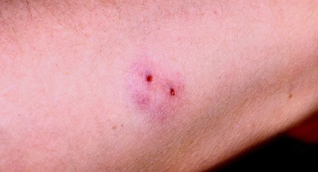 Snake bite patients, do not endanger lives .. Do not seek village remedies, seek medical treatment .. | सर्पदंशाच्या रुग्णांनो, जीव धोक्यात घालू नका.. गावठी उपाय नको, वैद्यकीय उपचार करा.. Snake bite patients, do not endanger lives .. Do not seek village remedies, seek medical treatment .. | सर्पदंशाच्या रुग्णांनो, जीव धोक्यात घालू नका.. गावठी उपाय नको, वैद्यकीय उपचार करा..