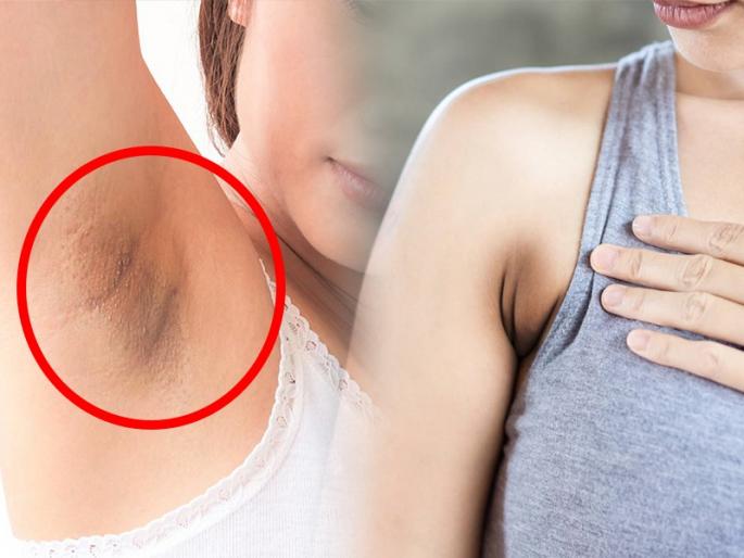 I like to wear sleeveless dresses, but ... I feel ashamed of the dark spots on my armpits? This is the best solution | स्लिव्जलेस ड्रेस घालायला आवडतात, पण...काखेतल्या काळपट डागांची लाज वाटते? त्यावर हे उत्तम उपाय
