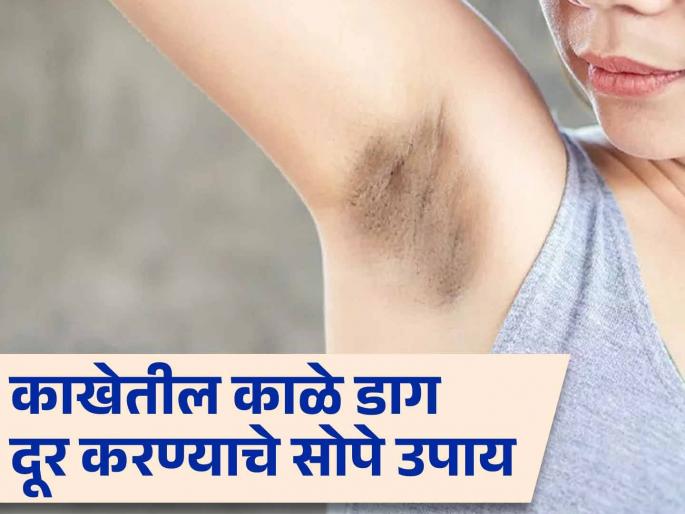 Get rid of dark spots in underarm with these home remedies | काखेतील काळे डाग दूर करण्याचे सोपे घरगुती उपाय, लगेच दिसेल फरक!