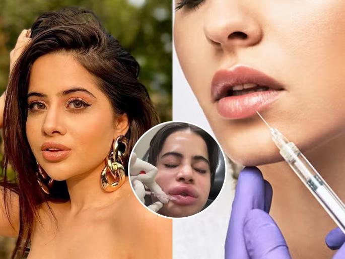 Uorfi Javed gets her lip fillers dissolved after 9 years, shares pictures of her swollen face Urfi Javed gets lip filler dissolved Uorfi Javed's filler dissolving procedure to fix misaligned lips leaves her face painfully swollen and red | ९ वर्षांनंतर उर्फी जावेदने काढले लिप फिलर्स आणि चेहरा सुजला भप्प, दिसतंय विचित्रच कारण...
