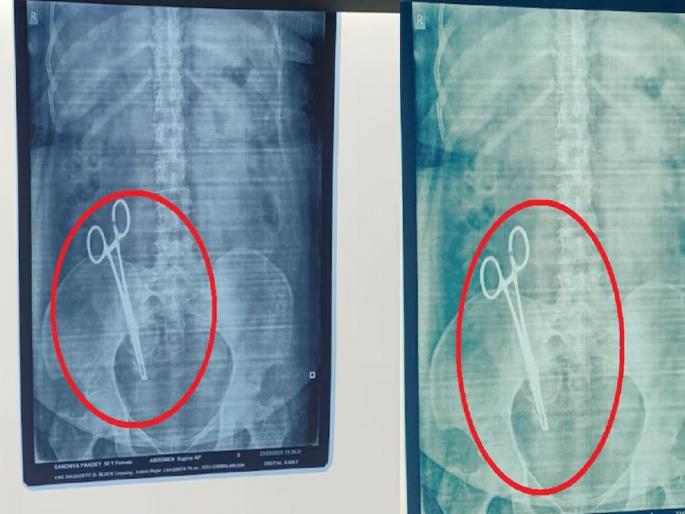UP News, Scissors left in woman's stomach during cesarean section, shocking incident revealed 17 years later | ऑपरेशनदरम्यान महिलेच्या पोटात कात्री राहिली, 17 वर्षांनंतर धक्कादायक प्रकार उघडकीस UP News, Scissors left in woman's stomach during cesarean section, shocking incident revealed 17 years later | ऑपरेशनदरम्यान महिलेच्या पोटात कात्री राहिली, 17 वर्षांनंतर धक्कादायक प्रकार उघडकीस