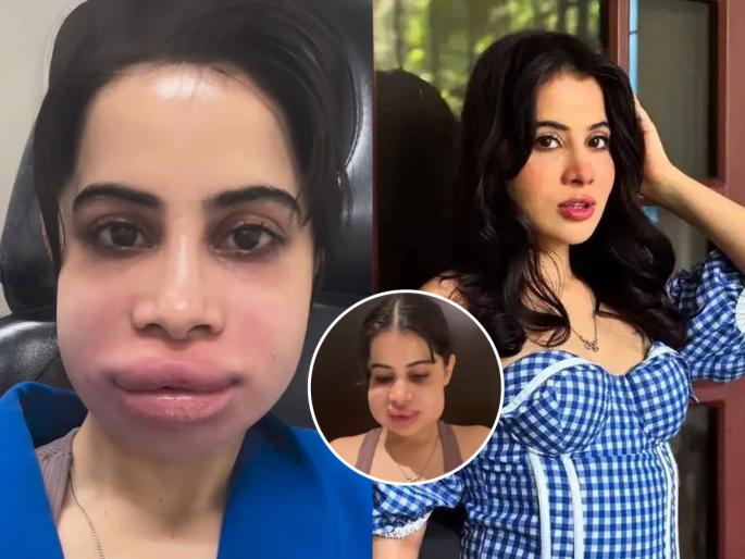Urfi Javed lips filler surgery what is dermal filler treatment side effects cosmetic surgery risks | उर्फी जावेदनं केलेली फिलर सर्जरी काय असते? धोका आणि परिणाम काय होतात, डॉक्टर सांगतात..