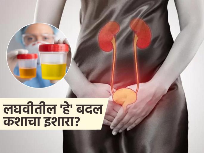 Urine changes can indicate about your health, Know what expert tells | डायबिटीस, कॅन्सर, किडनी इन्फेक्शन अशा आजारांचा खुलासा करतात लघवीतील 'हे' बदल