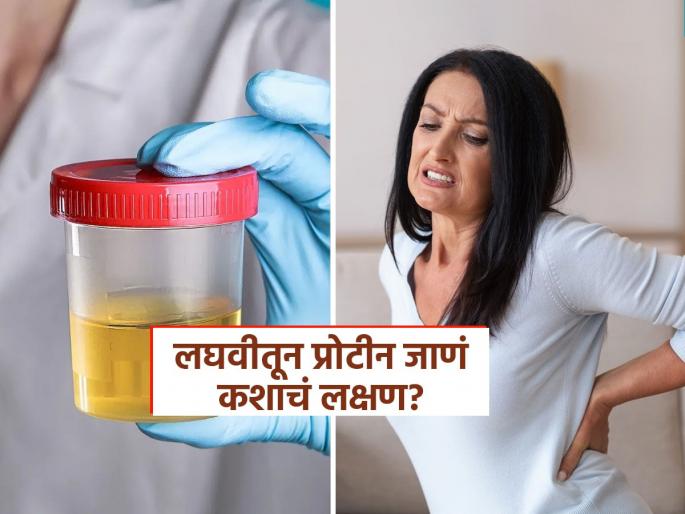 Causes and symptoms of protein leakage in urine, know how to stop leaking protein in urine | लघवीतून प्रोटीन बाहेर पडणं गंभीर आजाराचं लक्षण, पाहा प्रोटीन जातंय कसं ओळखाल आणि याची कारणं