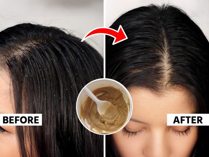 how to use baking soda for dandruff remove dandruff with baking soda baking soda dandruff treatment dandruff home remedy with baking soda Baking Soda For Dandruff | आणा बेकिंग सोडा, विसरा केसातला कोंडा! बेकिंग सोड्यासह ३ पदार्थ मिसळून केसांना लावा, कोंडा गायब...