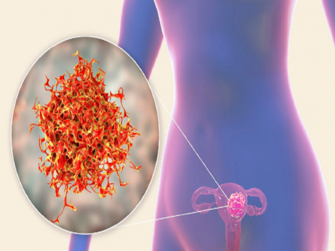 Having to remove the uterus every 17 days increases the risk of uterine cancer increase | दर १७ दिवसाला काढावी लागतेय एकीची गर्भपिशवी; गर्भाशयाच्या कॅन्सरचे प्रमाण वाढते