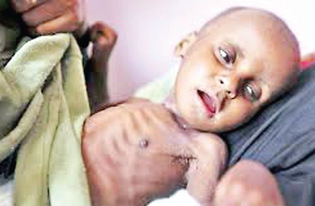 1 Extremely malnourished child found in Bhiwandi taluka | भिवंडी तालुक्यात आढळली ३८ अतितीव्र कुपोषित बालके 1 Extremely malnourished child found in Bhiwandi taluka | भिवंडी तालुक्यात आढळली ३८ अतितीव्र कुपोषित बालके